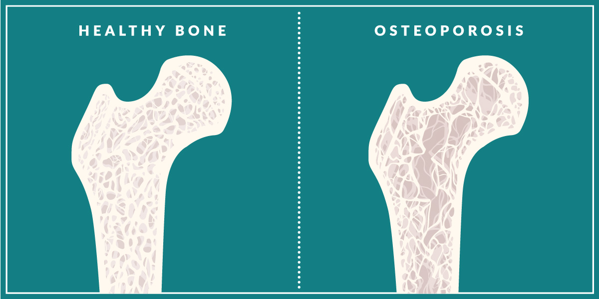 Graphics depicting a healthy bone and a bone with osteoporosis 
